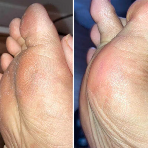 Gently remove calluses